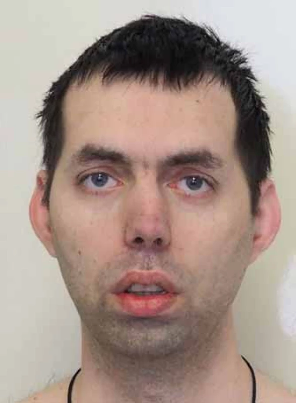 Typický vzhled pacienta s MD1.
Fig. 2. Typical facial appearance of a patient with MD1.