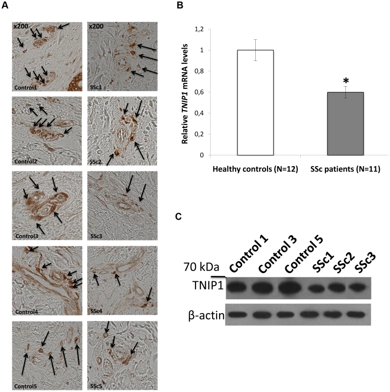 Decreased TNIP1 expression in SSc patients.