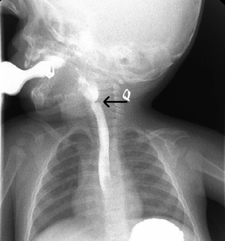 Ezofagografické vyšetrenie dieťaťa.
Fig. 1. Esophagographic examination of the child.