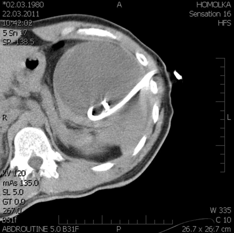 Punkce cysty pod CT (kazuistika 2)
Fig. 7: The cyst punctioning under CT (case 2)