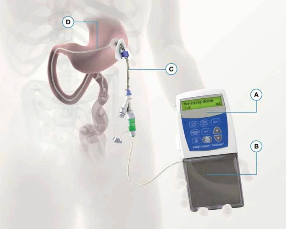 Schéma intestinálneho podávania L-Dopa/carbidopa gélu (upravené podľa propagačných materiálov Abbvie).
A – pumpa, B – kazeta s L-Dopa/carbidopa gélom, C – perkutánna endoskopická gastrostómia, D – intestinálna sonda.
Fig. 3. Jejunal infusion of L-Dopa/carbidopa intestinal gel (modified version of advertising material – Abbvie).
A – pump, B – L-Dopa/carbidopa intestinal gel cassette, C – perkutaneous endoscopic gastrostomy, D – intestinal tubing.