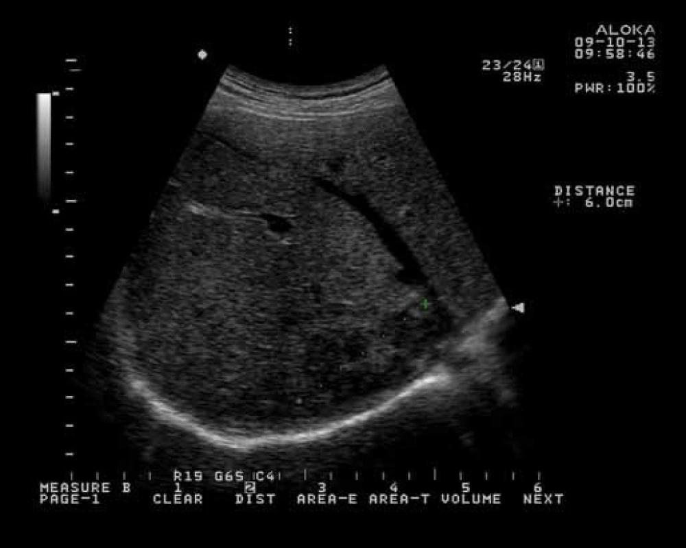Ultrasonografický nález heteroechogenního ložiska v ústí jaterních žil do vena cava.
Fig. 1. Ultrasound finding of heteroechoic mass in confluens of liver veins in vena cava.