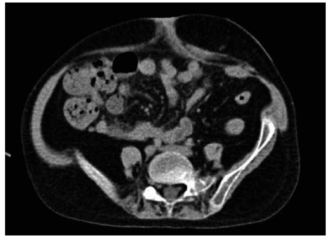 CT vyšetrenie brucha pacientky s Crohnovou chorobou s nálezom fistúl a abscesov 
v periumbilikálnej oblasti.
Fig. 2. Abdominal CT scan of Crohn‘s disease patient with periumbilical abscesses and fistulas.