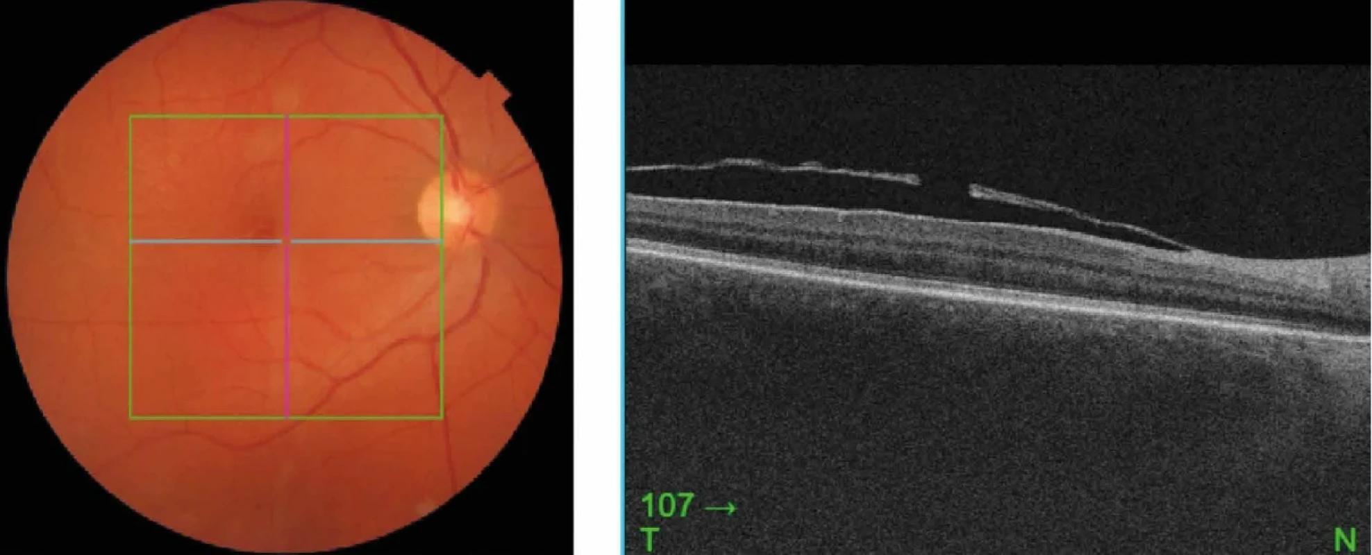 Optická koherenční tomografie (OCT) a fotografie zadního segmentu, kde je patrné fenestrum po Nd-YAG hyaloidotomii a vstřebané krvácení