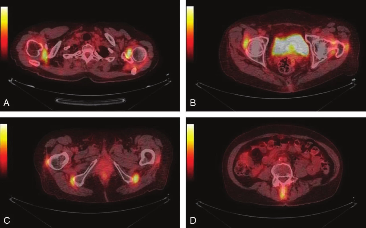 Hypermetabolismus <sup>18</sup>F-FDG v oblasti ramenních (A) a kyčelních (B) kloubů, 
v ichschiogluteálních (C) a interspinózních burzách (D). PET/ CT fúzované transverzální řezy.