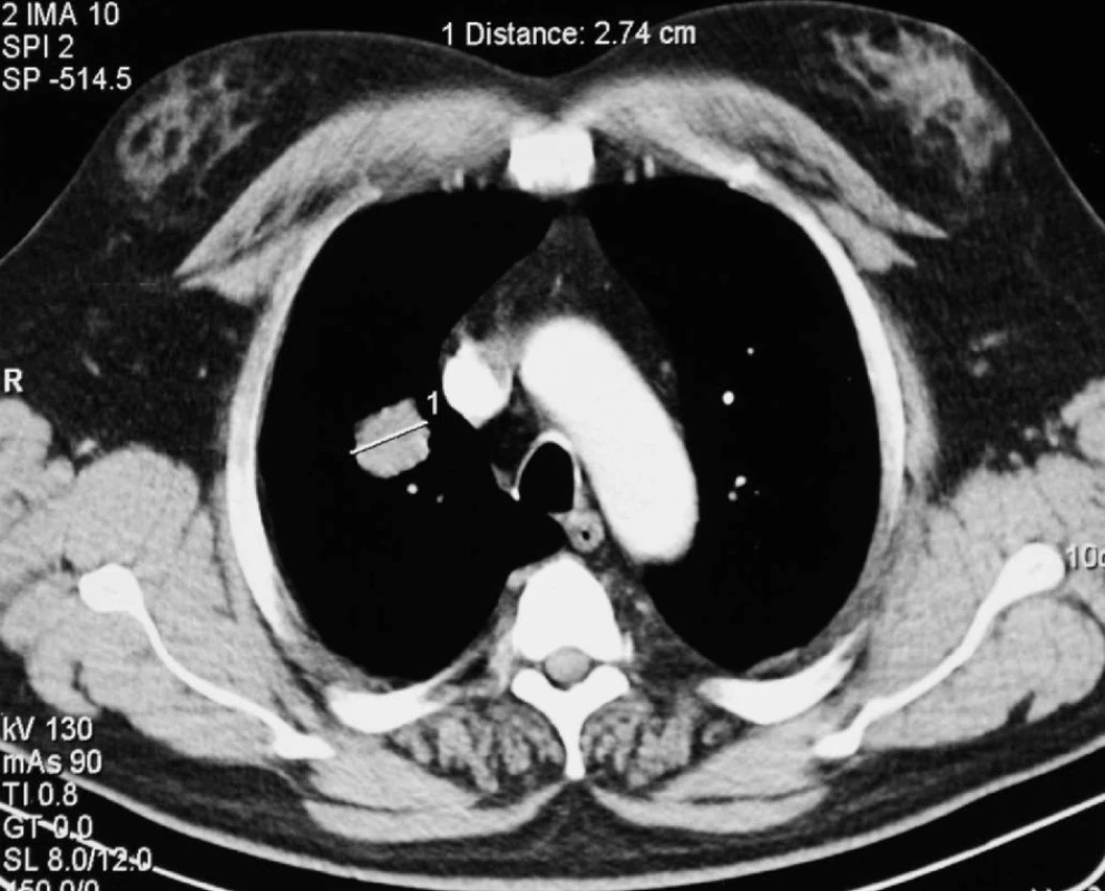 Předoperační CT plic – ložisko v S2 pravé plíce
Fig. 1: Preoperative lung CT scan – a focus in the right lung S2