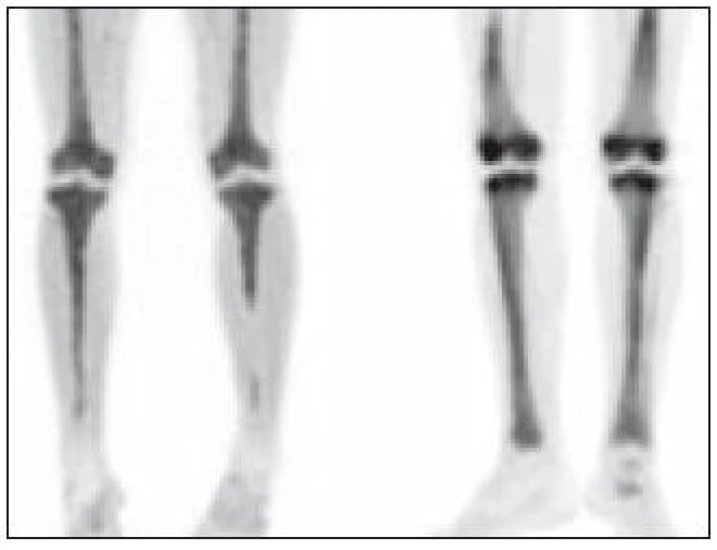 MIP (Maximum Intensity Projections) PET dolních končetin u 2 pacientů s Erdheimovou-Chesterovou chorobou, kterými lze získat trojrozměrnou představu o distribuci radiofarmaka fluorodeoxyglukózy (FDG).

Ložiska zvýšené akumulace radiofarmaka nacházíme u obou pacientů bilaterálně ve stehenních a bércových kostech s maximem postižení v oblasti distálních femorů a proximálních tibií.
