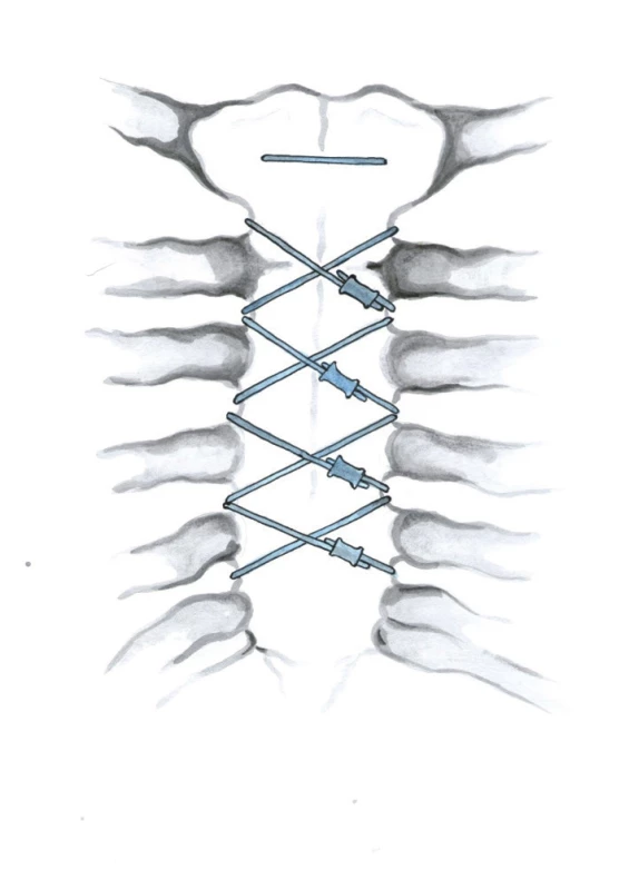 Kabelový systém (Kresba archiv autora)
Fig. 9: Cable system