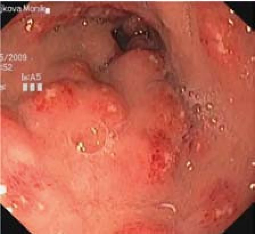 Povrchové aftoidní eroze v jejunu.
Fig. 3. Superficial aphtous erosions in the jejunum.