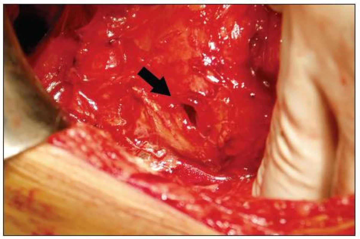 Perforace zadní stěny duodena
Fig. 4. Perforation of posterior wall of duodenum