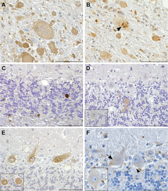 Immunohistochemistry indicates disturbed autophagic flow in neurons.