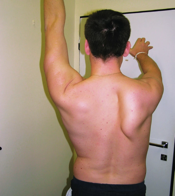 Scapula alata vpravo následkem léze n. thoracicus longus vpravo. Vázne elevace PHK nad horizontálou vzhledem k nedostatečné fixaci a nedostatečnému vytáčení pravé lopatky. U pacienta došlo k pozvolné úpravě stavu během 6 měsíců.