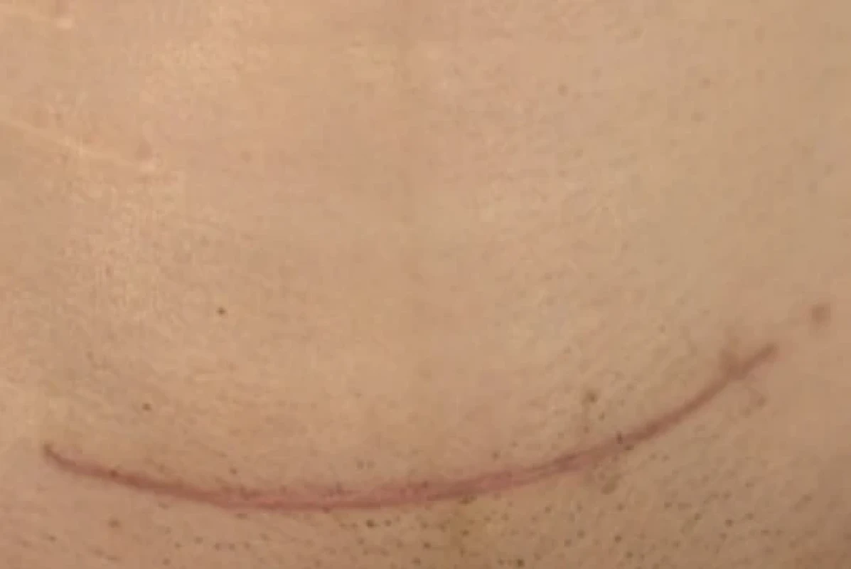 Hypertrofi cká jizva 3 měsíce po porodu císařským řezem (současně přítomna normotrofi cká jizva po apendektomii před 6 lety). Fig. 1. Hypertrophic scar 3 months after a cesarean section (along with a normotrophic scar from an appendectomy 6 years ago).