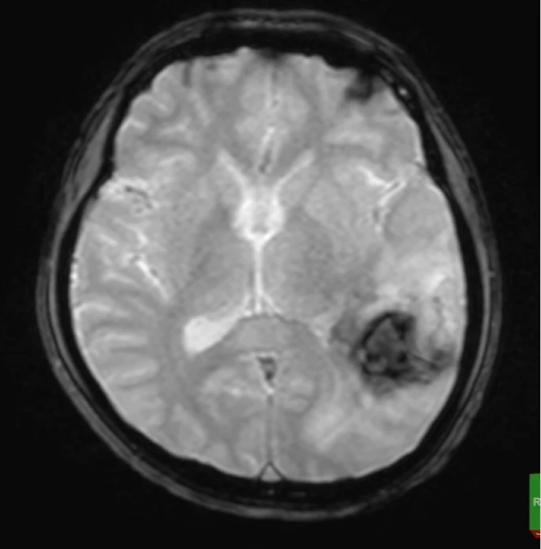 Obr. 6. Kontrolní MR mozku (FLAIR sekvence) po 7 dnech. .</br> Fig. 6. MR (FLAIR) after 7 days. 
