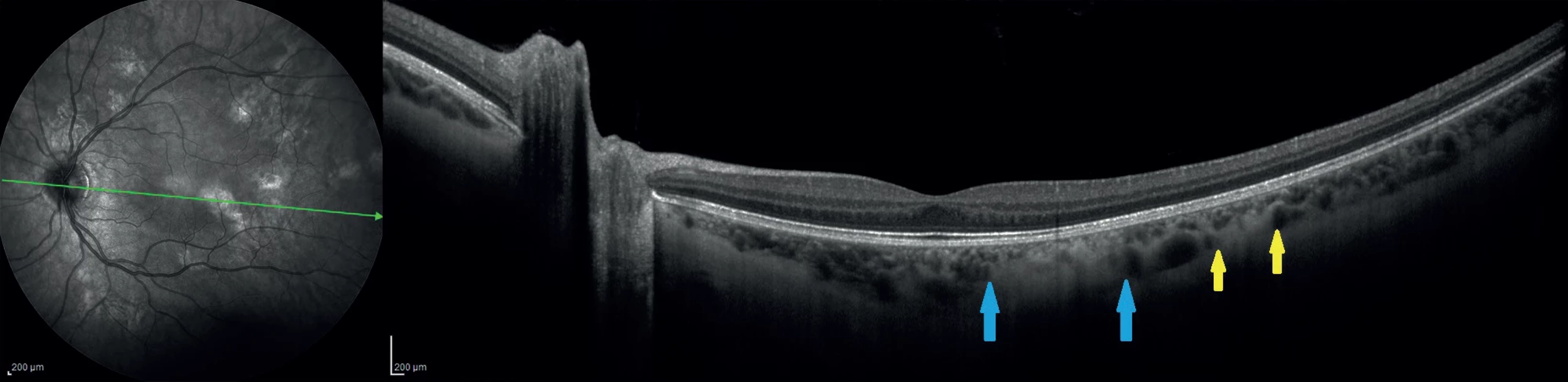 55° IR image with OCT section through two choroidal nodules shows a hyperreflective lesion touching the choriocapillaris layer (between the blue arrows) and the other, embedded in the deep choroid (between yellow arrows)