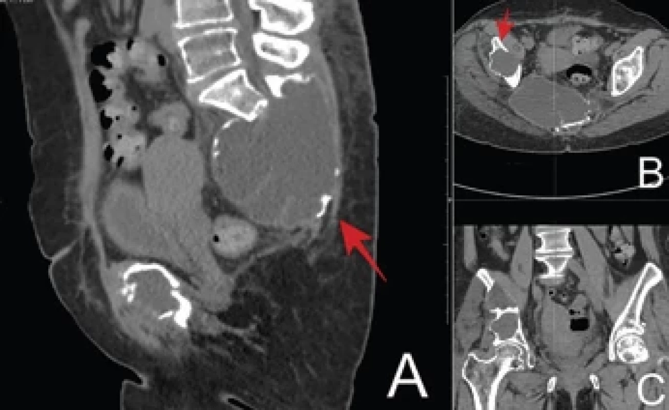 Computed tomography without contrast, in a soft tissue window, in the sagittal (A), axial (B) and coronal (C) planes. The destructive (osteolytic) lesion is visualized, compromising all the coccygeal parts and, extending posteriorly, involving the posterior elements of the lumbosacral spine (arrow in A) and acetabular on the right (arrow in B). The uterus has normal morphology and there is no ascites.