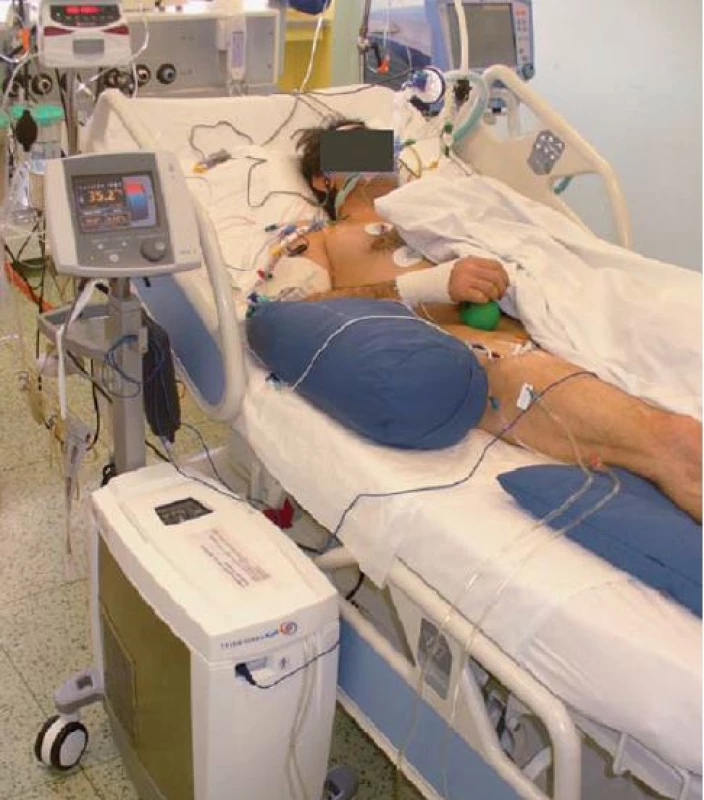 Endovaskulární hypotermie – system Thermogard.