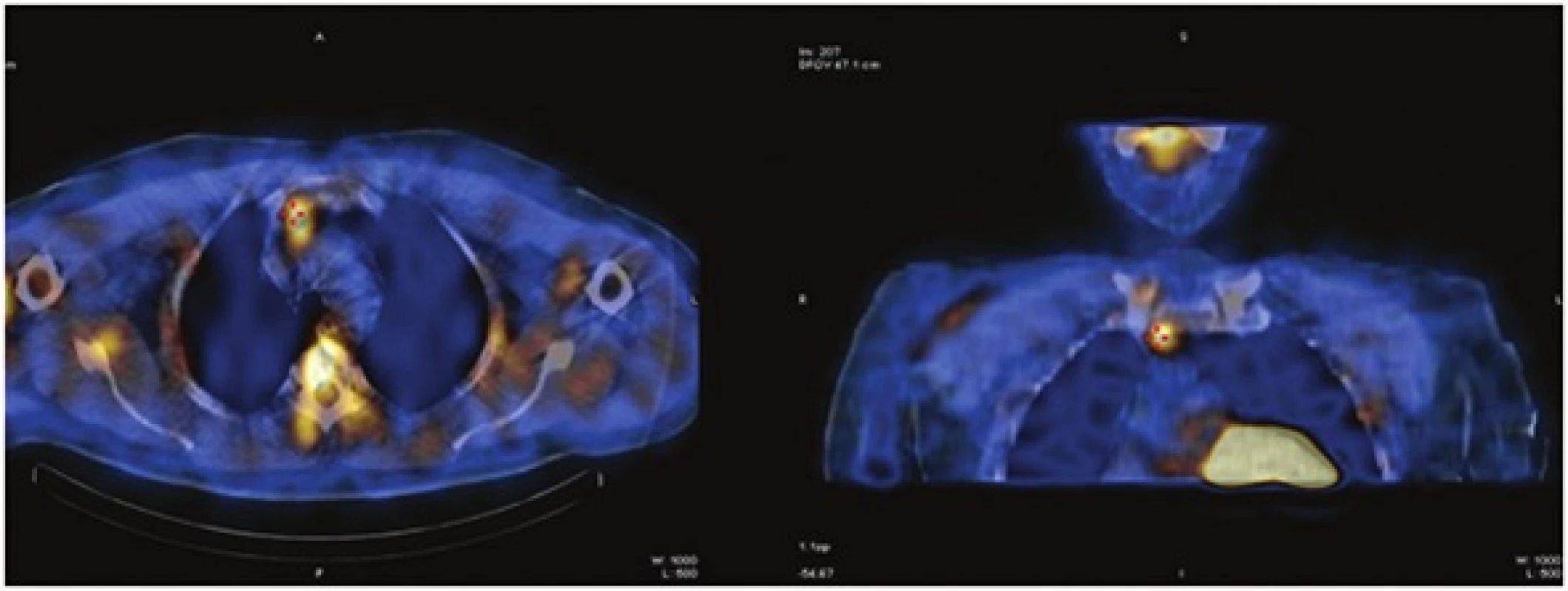 Scintigrafické vyšetření 99mTc MIBI SPECT/CT v roce 2013
Fig. 2: 99mTc MIBI-scintigraphy combined with CT in 2013
