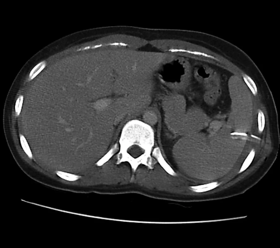 Chybné zavedení hrudního drénu do sleziny
Fig. 5: Misplacement of the chest drain into the spleen