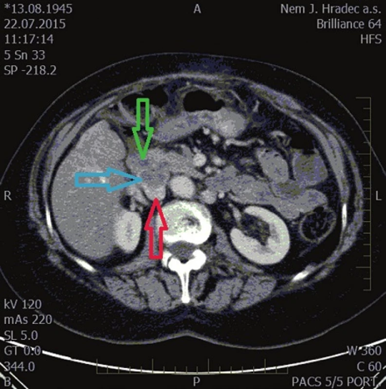 Horizontální řez CT enterografie z července 2015, kde při prvním čtení nebyl tumor odhalen (modrá šipka − tumor, červená šipka − vena cava inferior, zelená šipka − duodenum)
Fig. 2: CT enterography horizontal cross section of July 2015, which failed to recognize the tumor (blue arrow − tumor; red arrow − vena cava inferior; green arrow − duodenum)