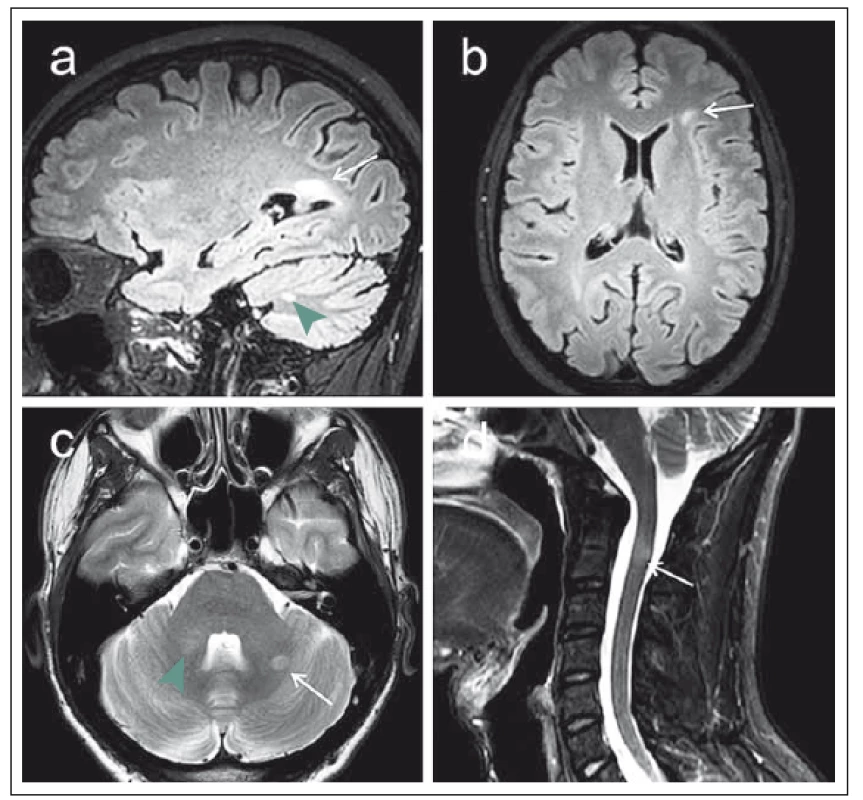 MR vyšetření na 3T přístroji u 29letého pacienta s klinickým obrazem klinicky izolovaného syndromu (CIS).
Fig. 1. MRI examination on a 3T device in a 29-year-old patient with a clinically isolated syndrome (CIS) clinical image.