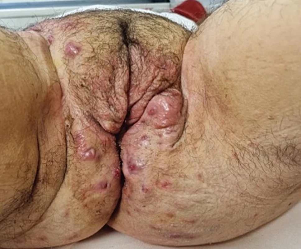Prejavy HS perigenitálne a v oblasti slabín, vrátane supurujúcich fi stúl (zdroj: archív Kliniky dermatovenerológie UNLP Košice).