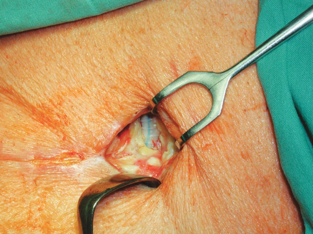 Stav po nekrektomii před přiložením V.A.C.
Fig. 2. A wound after necrectomy before V.A.C. application