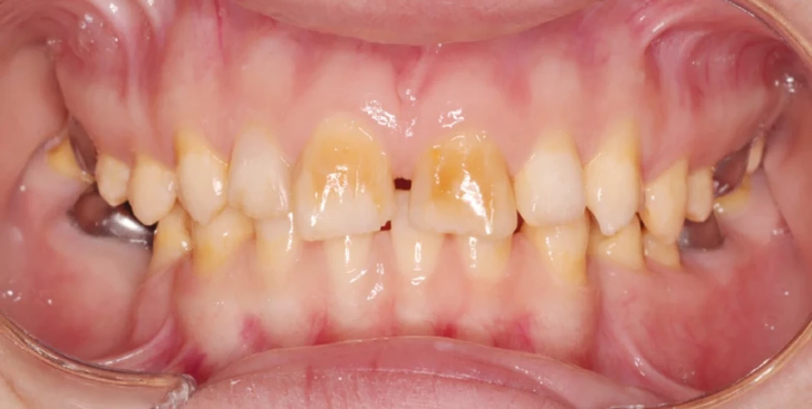 Intraorální fotografie pacienta s kombinovanou formou amelogenesis imperfecta. Zuby jsou menší, zároveň je viditelné zbarvení zubní skloviny odpovídající hypomaturačním defektům. Archiv obrazové dokumentace Stomatologické kliniky FNKV, 3. LF UK a Rozštěpového centra FNKV Praha. Fig. 4 Intraoral image of a patient with the combined form of amelogenesis imperfecta. The teeth are smaller and enamel discoloration consistent with hypomaturation defects is visible. Archive of Department of Stomatology, 3rd Faculty of Medicine, Charles University, and University Hospital Kralovske Vinohrady, and Cleft Centre Prague, University Hospital Kralovske Vinohrady.