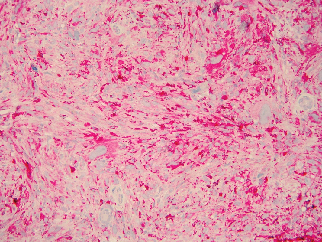 Imunohistochemické vyšetření – pozitivita CD68