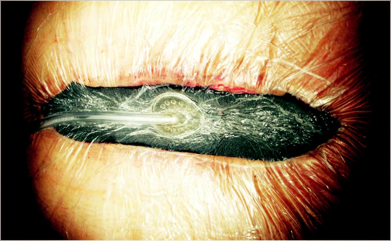 Hluboká sternální infekce. Aktivní podtlaková terapie
Fig. 3. Deep sternal infection. Working VAC therapy