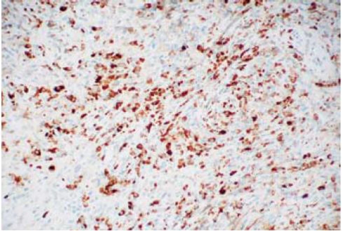 Difuzní exprese IgG4 v polyklonálních plazmatických buňkách zánětlivého infiltrátu.
Fig. 2. Diffuse expression of IgG4 in polyclonal plasmatic cells of the inflammatory infiltrate.