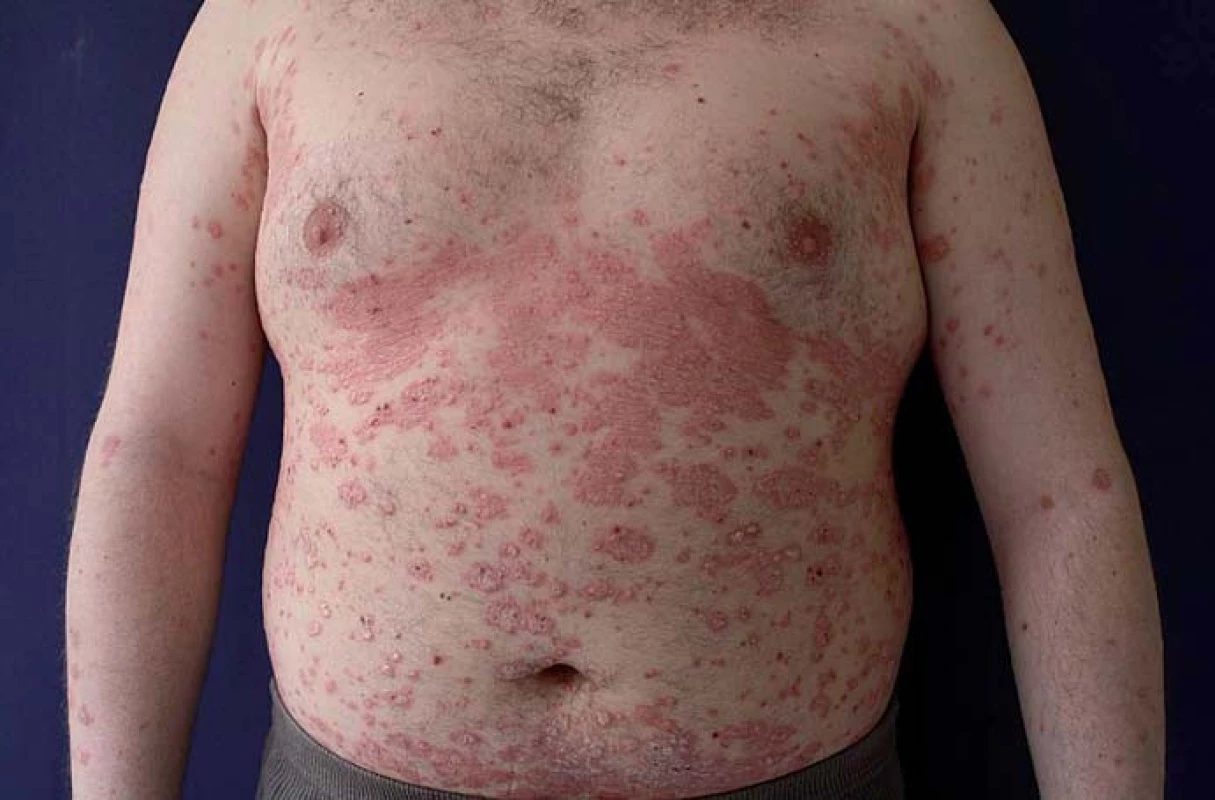 Psoriáza.
Fig. 7. Psoriasis.