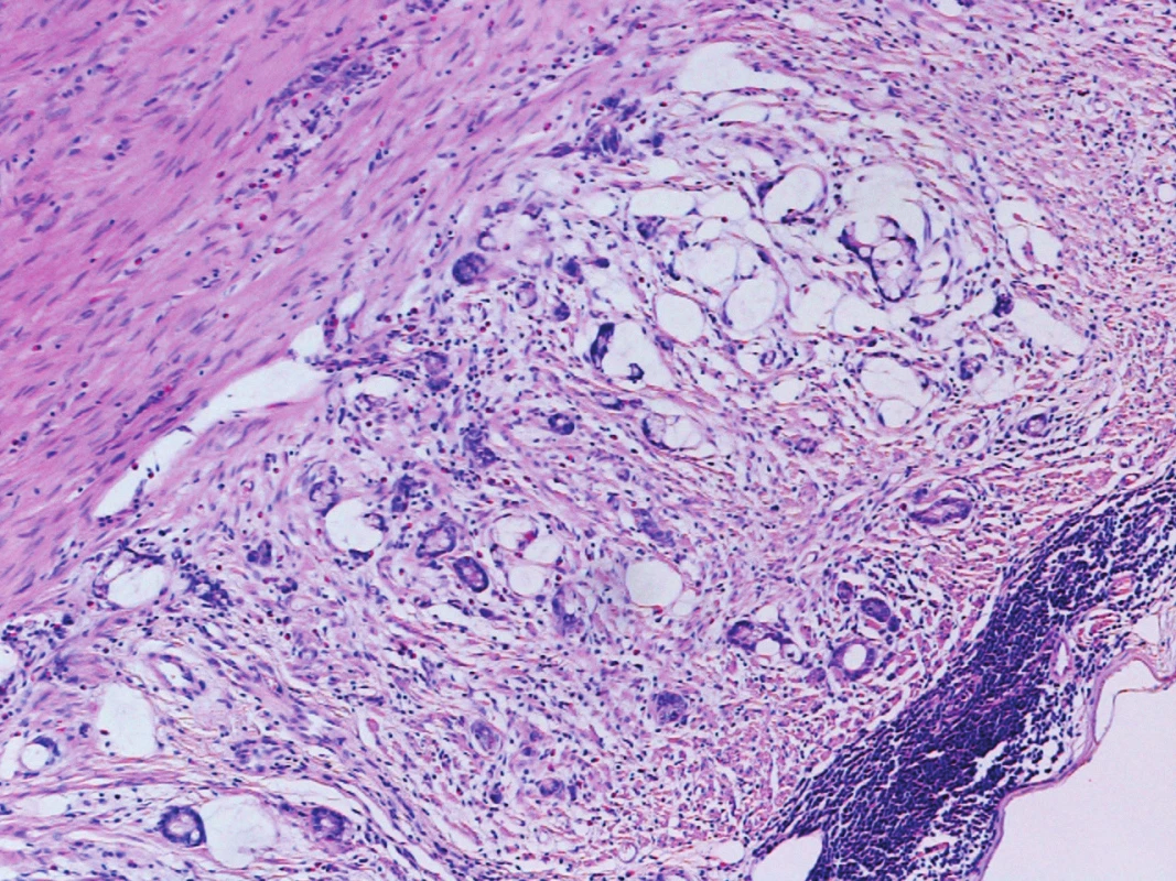 Trabekulární a tubulární struktury karcinomu infiltrující muscularis propria apendixu 
Originální zvětšení 100x, HE (hematoxylin, eosin).
Fig. 5: Trabecular and tubular carcinoma structures infiltrating muscularis propria layer of the appendix 
Original magnification 100x, HE (haematoxylin, eosin).