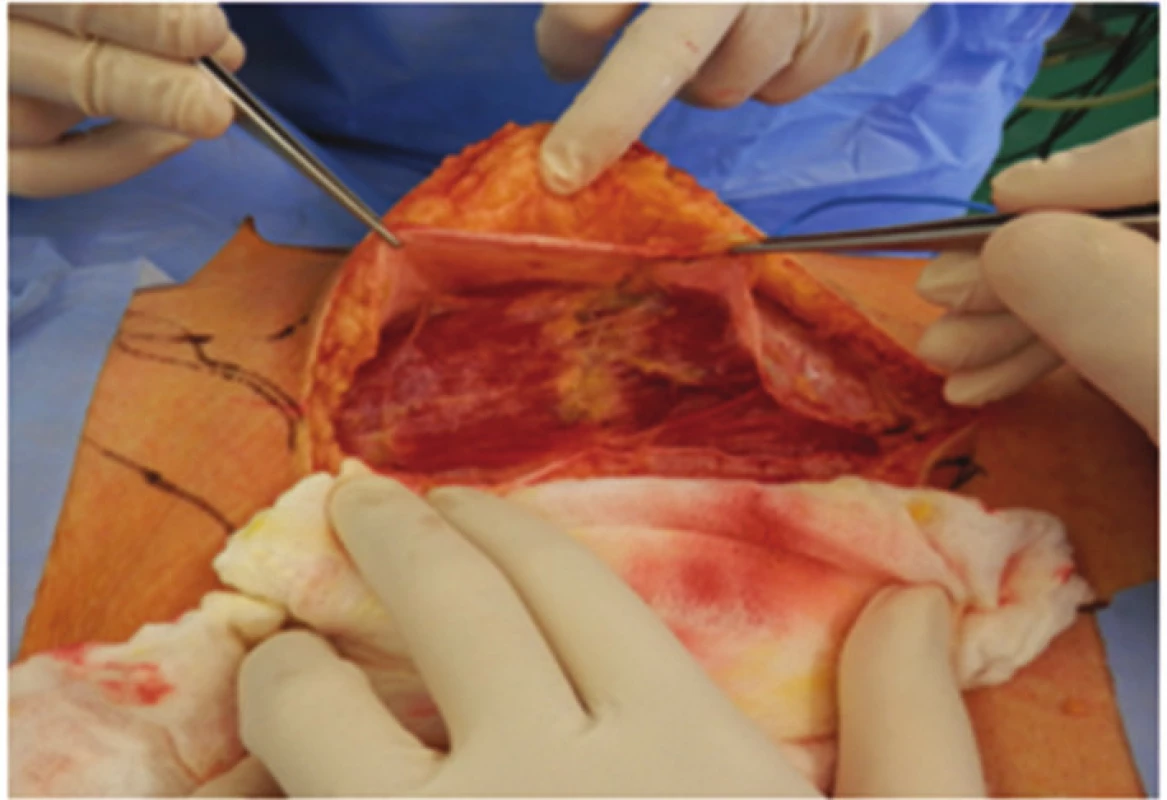 Pochva m.rectus abdominis otevřena mediálně vedenou incizí
Fig. 4: Rectus abdominis muscle sheath opened throught medial incision
