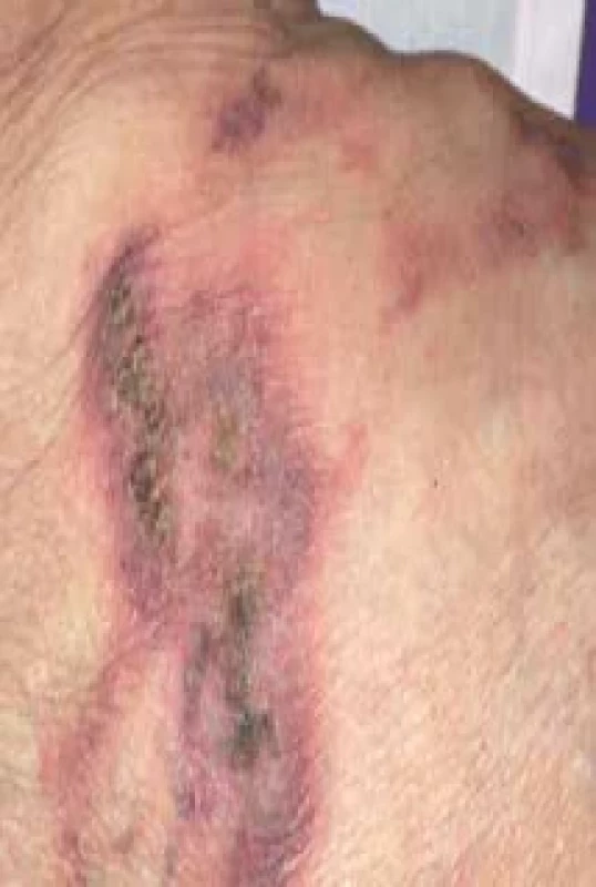 Klinický obraz pankreatické panikulitidy