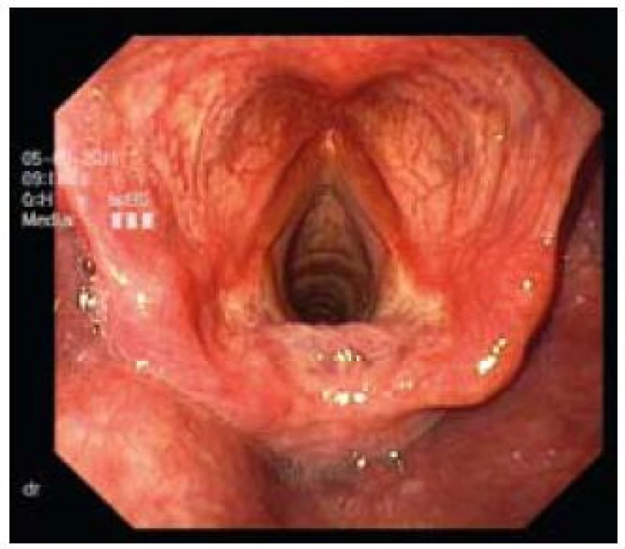Těžká forma laryngitidy.
Fig. 12. Severe laryngitis.