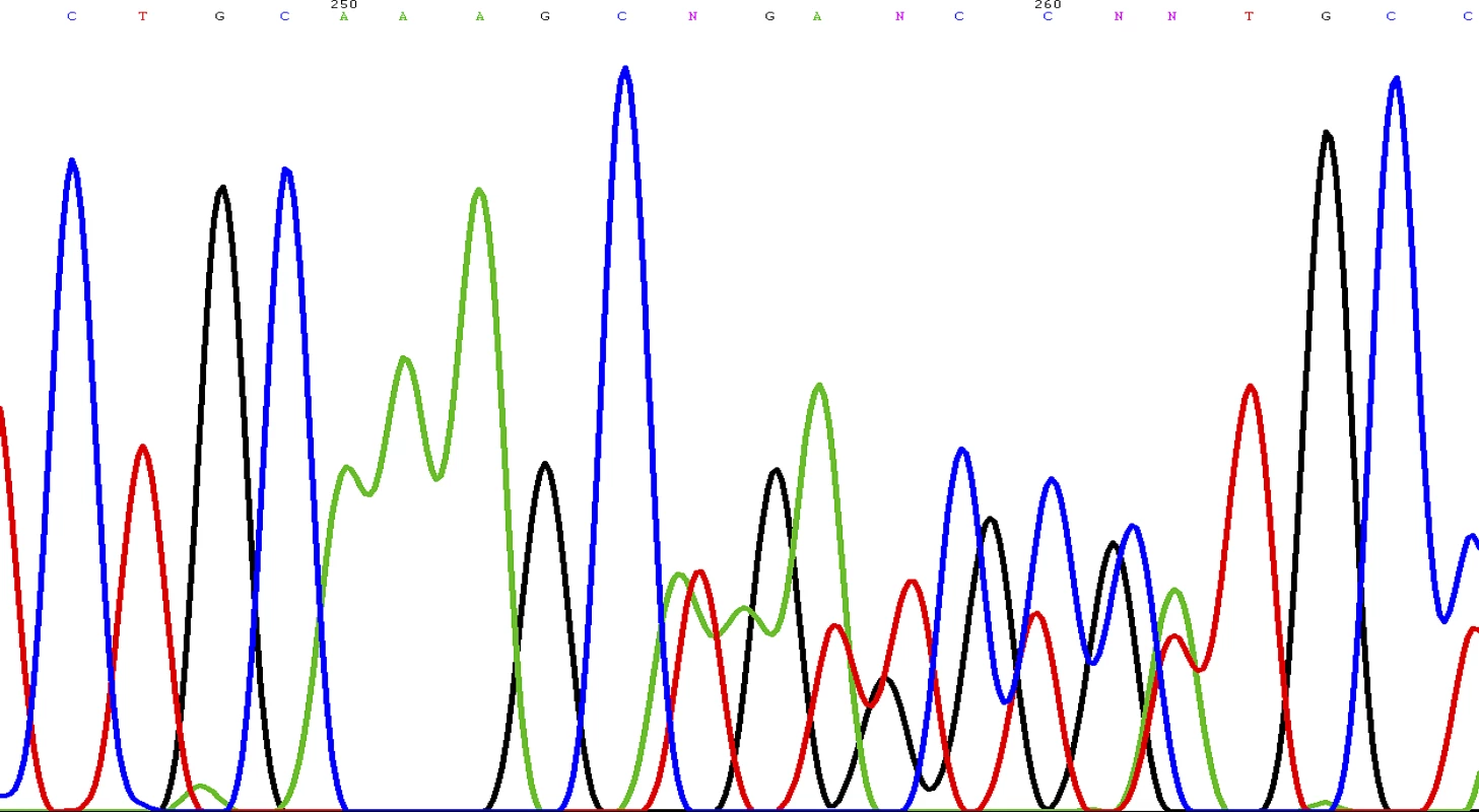 Sequence Chromatogram Showing the Novel Frameshift Mutation of the <i>SDHD</i> Gene: c.449_453dup (p.Val153LysfsX17)