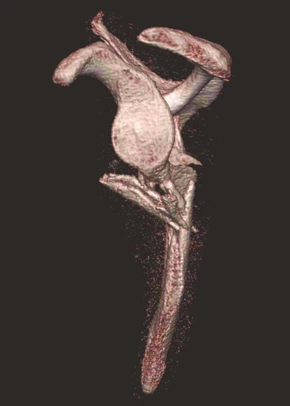 Třídimenzionální CT rekonstrukce – pohled z laterální strany Je vidět intaktní glenoid.
Fig. 4: Three-dimensional CT reconstruction – lateral view showing the intact glenoid