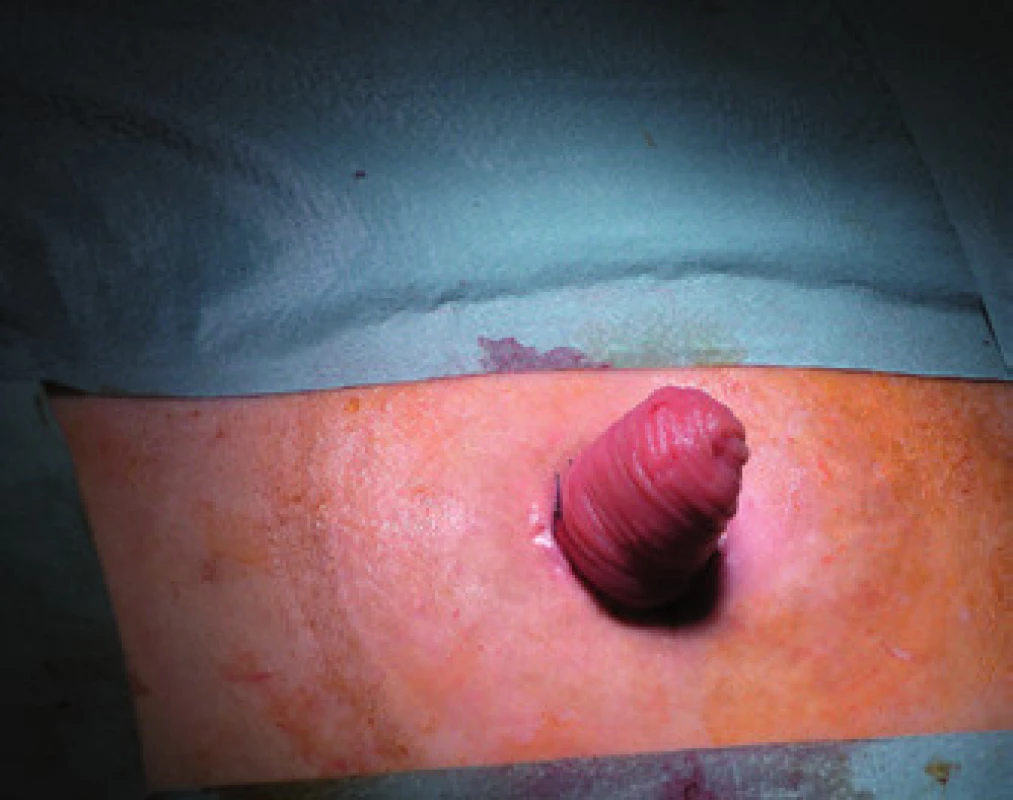 Ileus z obstrukce pojistné ileostomie.
Fig.3. Small bowel obstruction associated with ileostomy.