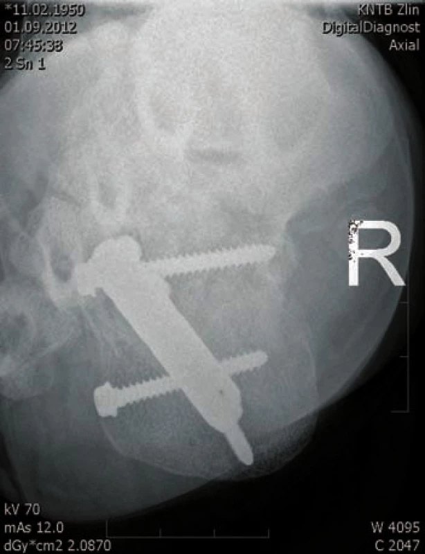 Osteosyntéza hřebem C nail Medin - axiální projekce