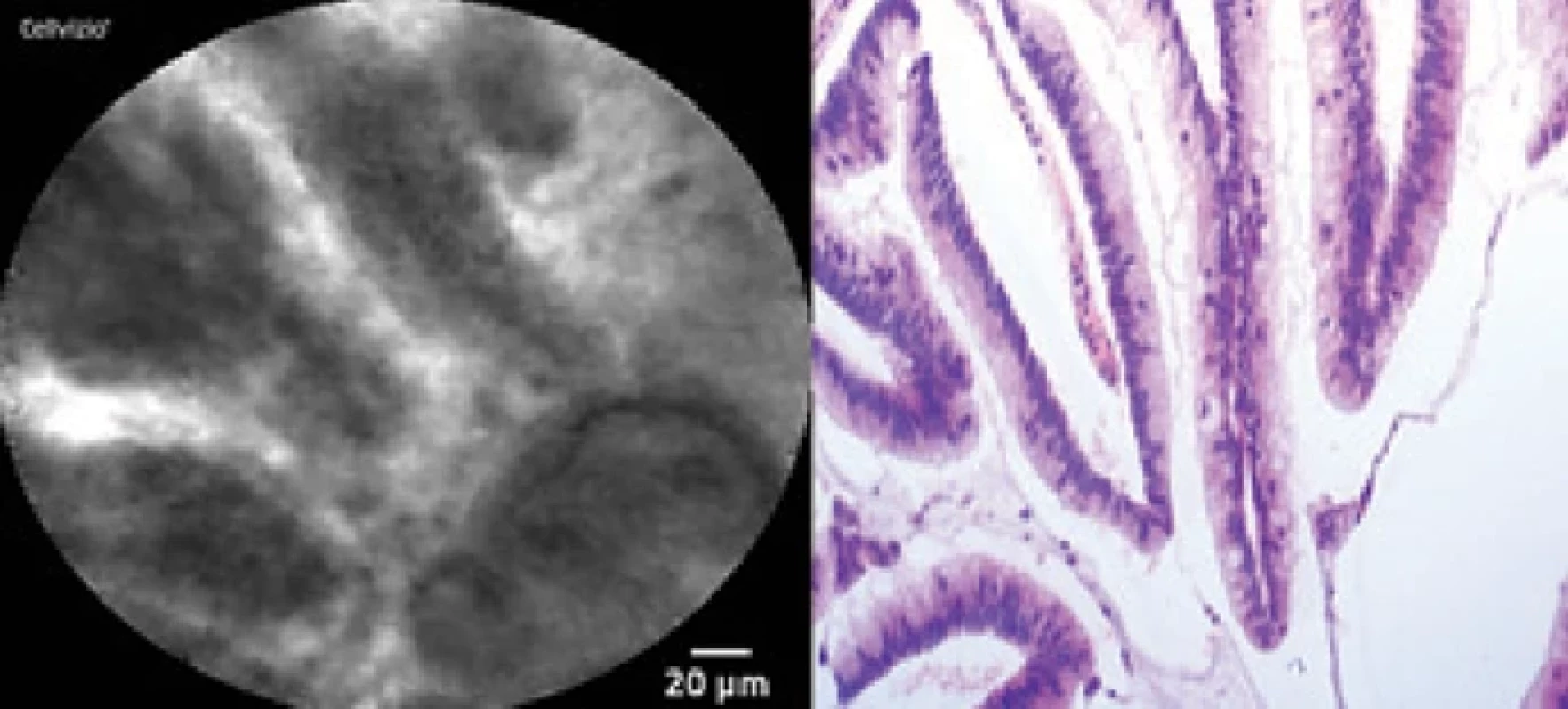 IPMN – typické prstovité papilární struktury – v nCLE obraze (vlevo) tmavší line- ární útvary s tmavými jádry buněk a světlými středy, v histologickém obraze (vpravo) papily kryté jednou řadou cylindrických mucinózních buněk s bazálně umístěnými jádry. 