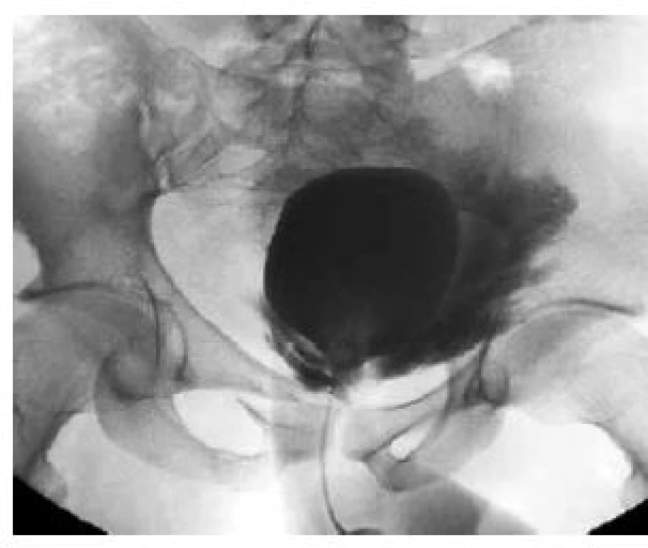 Cystografie – extraperitoneální ruptura močového měchýře
Fig. 8. Cystography – extraperitoneal rupture of the urinary bladder