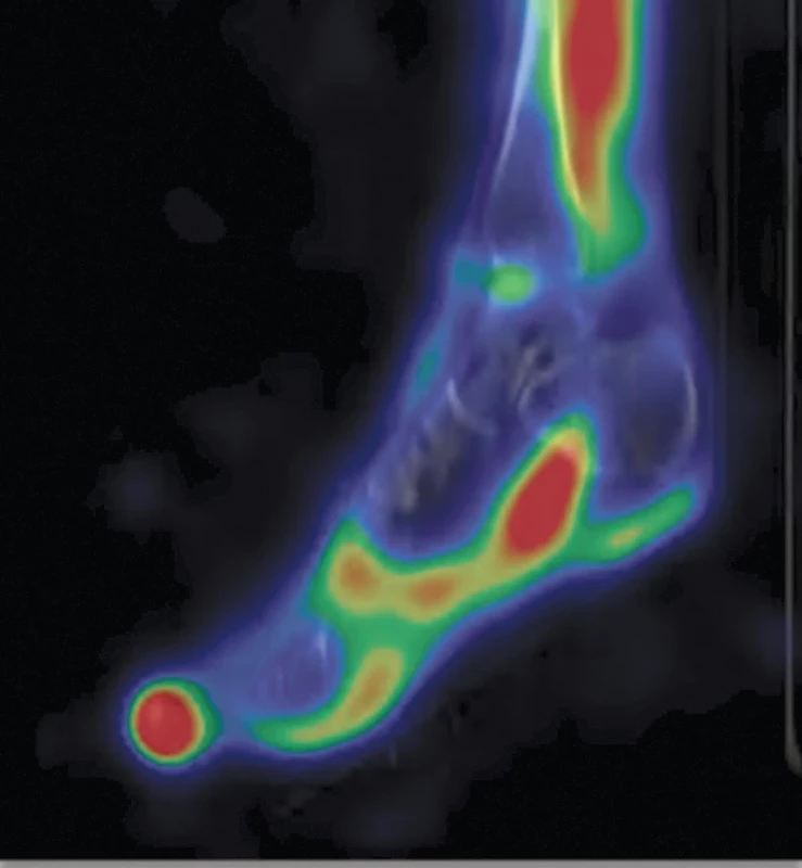 Fúze SPECT/CT pravého tarzu v časné fázi v sagitálním řezu – vyšší krevní pool v oblasti osteochondrálního defektu v kloubní ploše kladky pravého talu.