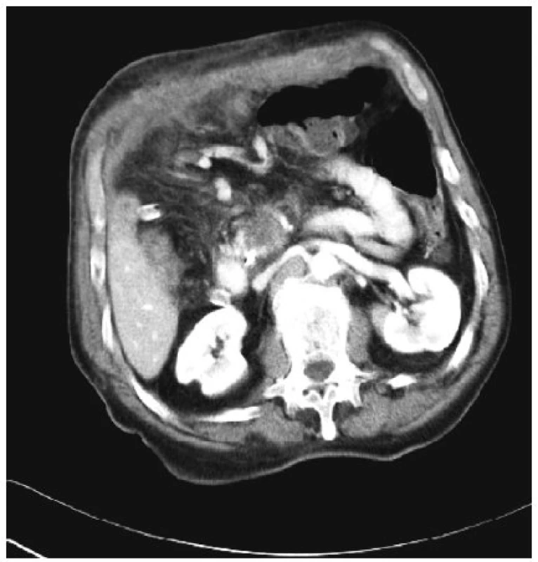 Tentýž tumor těla pankreatu 7 dní po RFA
Fig. 4. The same tumor of the pancreatic head 4 days after the RFA procedure