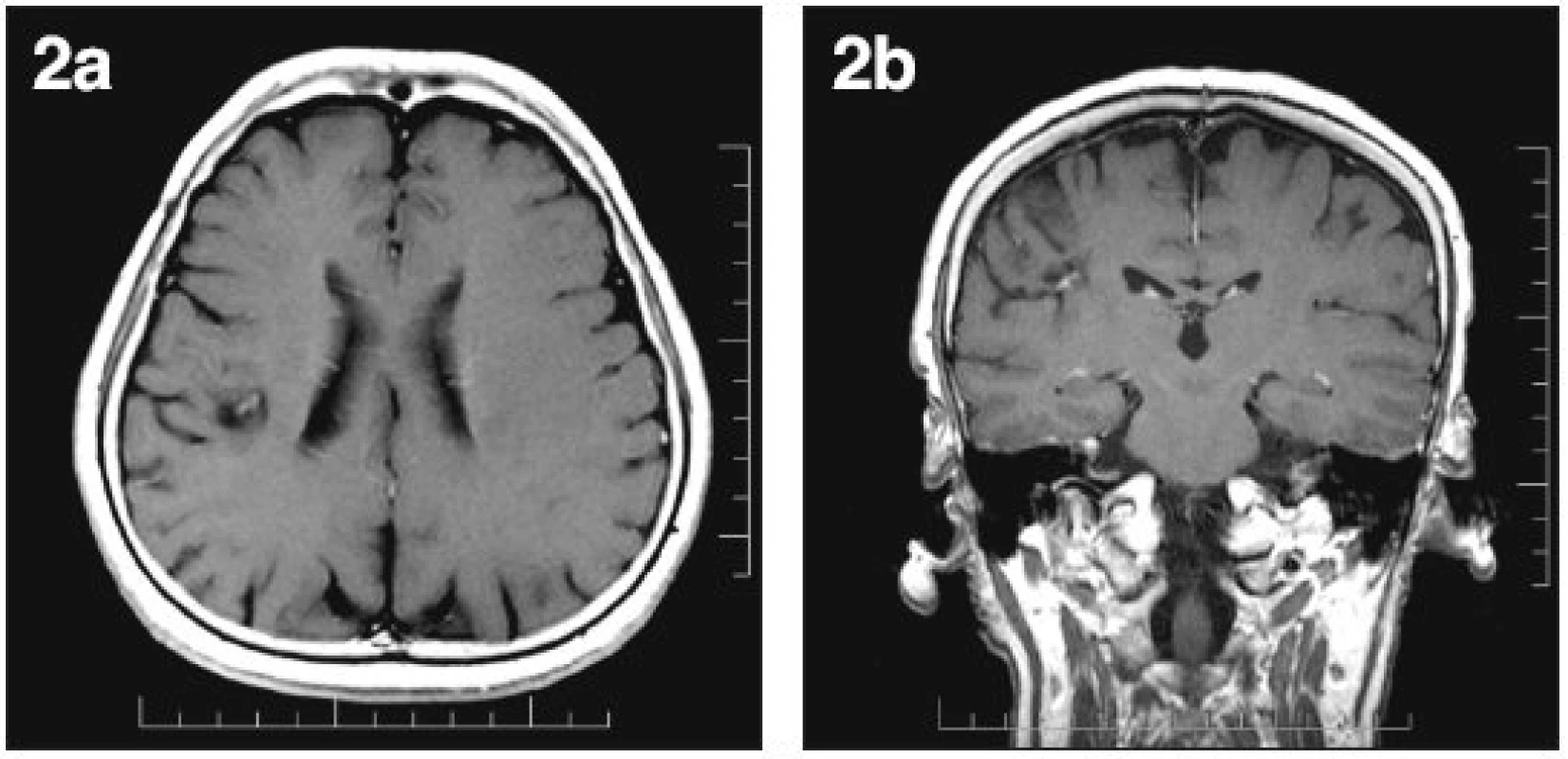 Stav po provedené termoablaci DNET, bez známek postkontrastního sycení s výjimkou větve arteria cerebri media a) axiální MRI scan, b) koronární MRI scan
Fig. 2. Status post DNET thermoablation, without signs of delayed enhancement except the arteria cerebri media branch a) axial MRI scan, b) coronary MRI scan
