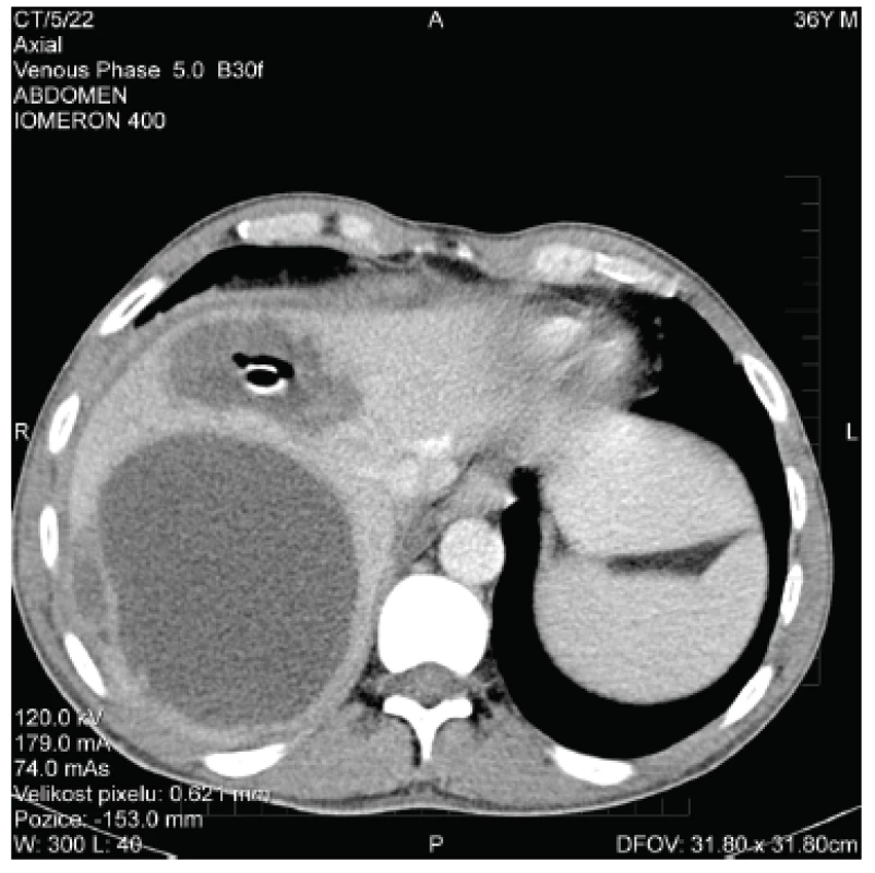 CT obraz jaterních abscesů po chirurgické drenáži
Fig. 2. CT scan of liver abscesses after surgical drainage