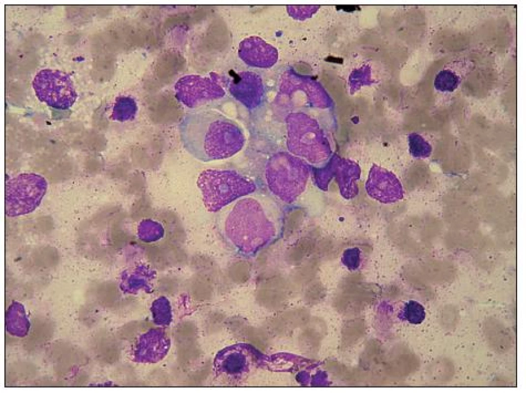 Neuroblastom – pro srovnání otisk primárního tumoru. Rozetovitý útvar neuroblastomových buněk s ganglioidní
diferenciací. Velká světlá, částečně excentricky uložená jádra, s velkými jadérky. Místy vakuoly v cytoplazmě. V pravé horní části rozetky ojedinělé fagocytované erytrocyty.