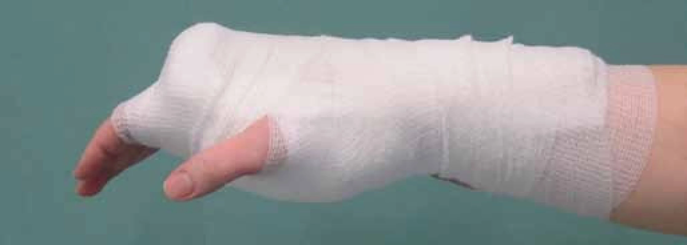 Dorzální dlaha zápěstí v neutrální poloze pro pacienty zařazené do skupiny A.