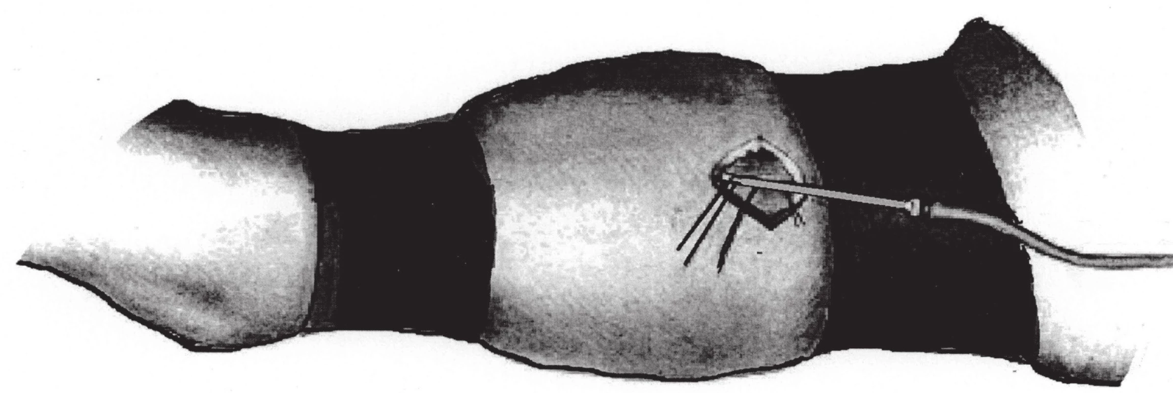 Původní metoda intravenózní regionální anestezie (překresleno podle [12])