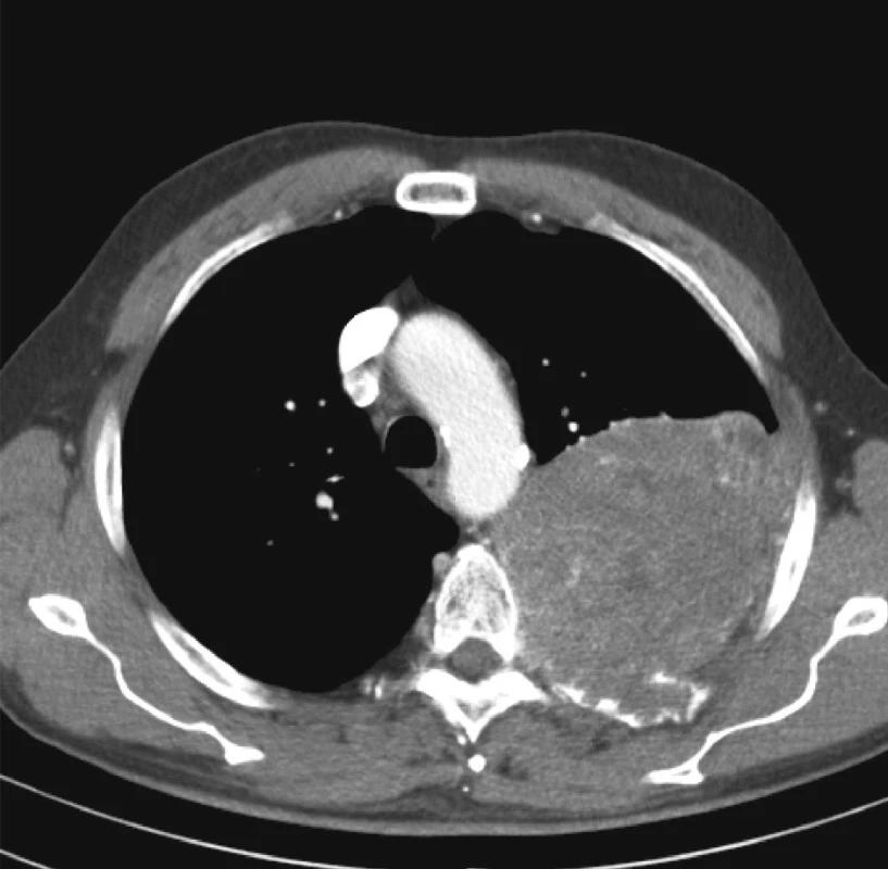 Infiltrativně rostoucí SFT do hrudní stěny a příčných výběžků hrudních obratlů
Fig. 1. SFT infiltrating the thoracic wall and transverse processi of spinal vertebrae